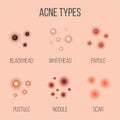 Creative vector illustration types of acne, pimples, skin pores, blackhead, whitehead, scar, comedone, stages diagram Royalty Free Stock Photo