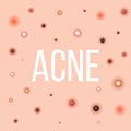 Creative vector illustration types of acne, pimples, skin pores, blackhead, whitehead, scar, comedone, stages diagram