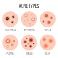 Creative vector illustration types of acne, pimples, skin pores, blackhead, whitehead, scar, comedone, stages diagram Royalty Free Stock Photo