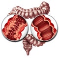 Crohn Disease And Healthy Intestine