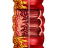 Crohn\'s Disease