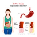 Crohn`s disease. Crohn`s syndrome. regional enteritis Signs and symptoms