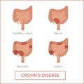 Crohn's disease