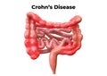 Crohn`s disease is a syndrome that affects the digestive system. Its symptoms are abdominal pain associated with diarrhea, fever,