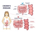 Crohns disease as inflammatory bowel problem explanation outline diagram Royalty Free Stock Photo