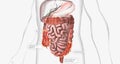 Crohns disease is a type of chronic inflammatory bowel disease