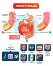 Crohns disease vector illustration. Labeled diagram with diagnosis. Royalty Free Stock Photo