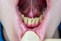 Crooked teeth in the anterior part of the patient, at the reception of the orthodontist dentist, crooked incisors, crowded teeth,