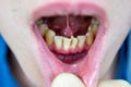 Crooked teeth in the anterior part of the patient, at the reception of the orthodontist dentist, crooked incisors, crowded teeth,