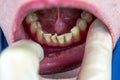 Crooked teeth in the anterior part of the patient, at the reception of the orthodontist dentist, crooked incisors, crowded teeth,