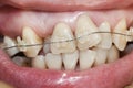 Crooked teeth with braces. Royalty Free Stock Photo