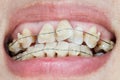 Crooked teeth with braces. Royalty Free Stock Photo