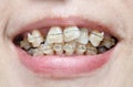Crooked teeth with braces. Royalty Free Stock Photo