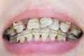 Crooked teeth with braces Royalty Free Stock Photo