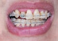 Crooked teeth with braces