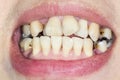 Crooked teeth before braces Royalty Free Stock Photo