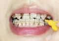 Crooked teeth with braces, interdental brushing Royalty Free Stock Photo