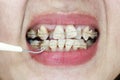 Crooked teeth with braces and plaque remover Royalty Free Stock Photo