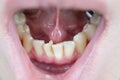 Crooked teeth on the lower jaw, crowding of teeth in the anterior part, crowded Royalty Free Stock Photo