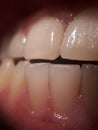 Crooked teeth on the lower jaw, crowding of teeth in the anterior part,