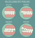 Crooked teeth. Malocclusion problems.