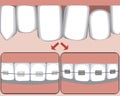 Crooked teeth on the upper jaw as a concept for bite treatment, vector stock illustration with molars with ceramic or metal braces