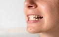 Crooked and yellow teeth. Woman has malocclusion. Adult orthodontics problem and treatment. Somatology medicine