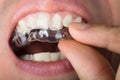 Man Adjusting Transparent Aligners In Teeth