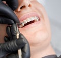 Cropped macro snapshot of teeth with ceramic and metal brackets at dentist office Royalty Free Stock Photo