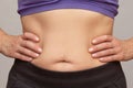 Cropped woman body with hands on waist showing belly sagging skin after diet and stretch marks Royalty Free Stock Photo