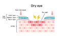 Cross section of dry eye surface. flat vector illustration Royalty Free Stock Photo