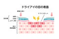 Cross section of dry eye surface. flat vector illustration Japanese Royalty Free Stock Photo