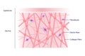 Cross section of high density of collagen, elastin fibers and fibroblasts in the dermis.