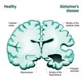 Cross section of the human brain. Healthy brain compared to Alzh Royalty Free Stock Photo