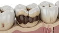 Severely decayed and cracked human teeth in cross-section on white background tooth dental Royalty Free Stock Photo