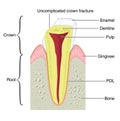 Cross section of a tooth with a crown frac Royalty Free Stock Photo