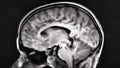 A crosssectional MRI image of the brain showing a large dark area in the left temporal lobe suggesting a possible