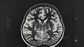 A crosssectional MRI image of the brain showing a large dark area in the left temporal lobe suggesting a possible