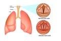 Croup laryngo-tracheo-bronchitis.