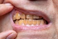 Crowded teeth with tobacco stains. Poor oral hygiene
