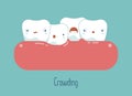 Crowding teeth ,dental concept