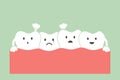 Crowding teeth malocclusion Royalty Free Stock Photo