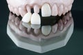 Prosthodontic Model