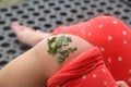 crushed binahong leaves attached to the leg of an injured child. Binahong leaves are fast in wound healing.