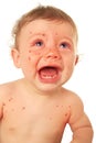 Crying baby boy with measles Royalty Free Stock Photo