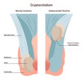 Cryptorchidism. Absence of one or both testes from the scrotum.