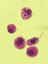 Crytpococcus neoformans encapsulated organism inside macrophage - CSF smear