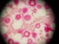 Crytpococcus neoformans stained with mucicarmine in lung biopsy