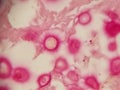 Crytpococcus neoformans stained with mucicarmine in lung biopsy