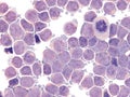 CSF involvement in acute lymphoblastic leukemia.